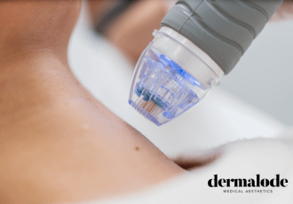 full microneedling at dermalode medical aesthetics in Randburg full microneedling at dermalode medical aesthetics in Randburg